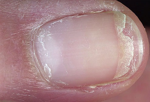 dermnet-photo-of-split-fingernail.jpg